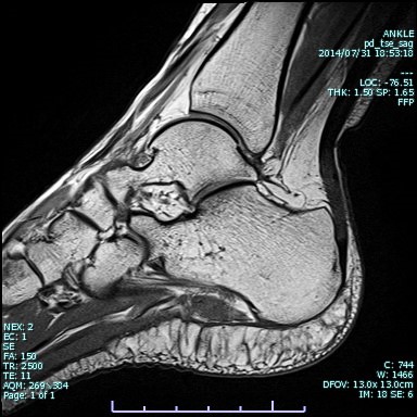 足関節MRI